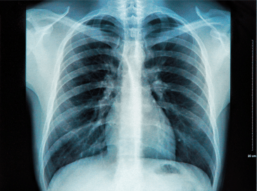 Chest X-ray